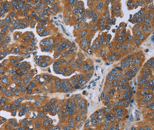 Immunohistochemistry of paraffin-embedded Human ovarian cancer using GAB2 Polyclonal Antibody at dilution of 1:50