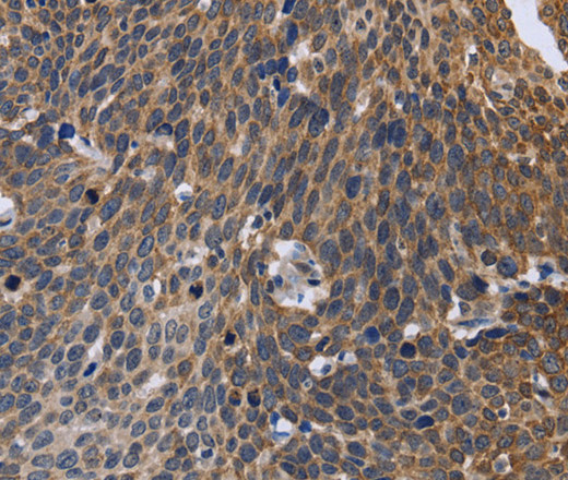 Immunohistochemistry of paraffin-embedded Human cervical cancer tissue using GABPB2 Polyclonal Antibody at dilution 1:30