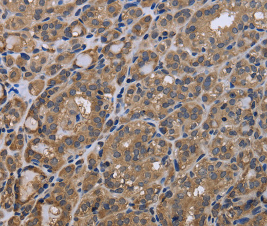 Immunohistochemistry of paraffin-embedded Human thyroid cancer tissue using GADD45B Polyclonal Antibody at dilution 1:40