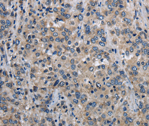 Immunohistochemistry of paraffin-embedded Human liver cancer using MCM3AP Polyclonal Antibody at dilution of 1:30