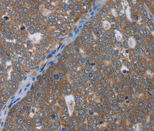 Immunohistochemistry of paraffin-embedded Human ovarian cancer using GABRB1 Polyclonal Antibody at dilution of 1:50