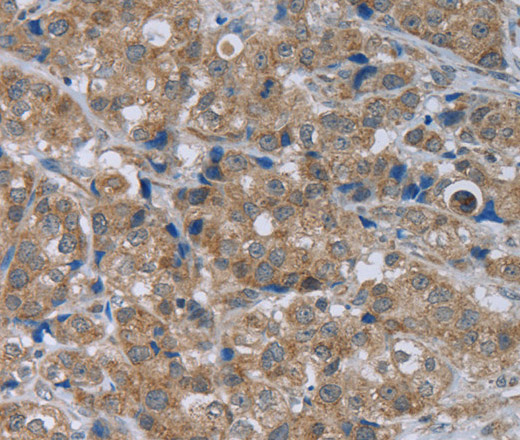 Immunohistochemistry of paraffin-embedded Human breast cancer using GABRB1 Polyclonal Antibody at dilution of 1:50