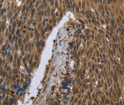 Immunohistochemistry of paraffin-embedded Human cervical cancer tissue using PIP Polyclonal Antibody at dilution 1:50