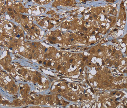 Immunohistochemistry of paraffin-embedded Human breast cancer tissue using GCK Polyclonal Antibody at dilution 1:60