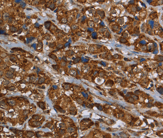 Immunohistochemistry of paraffin-embedded Human breast cancer tissue using GCKR Polyclonal Antibody at dilution 1:40