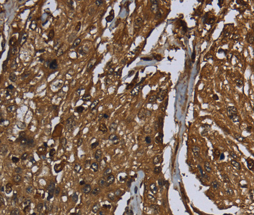 Immunohistochemistry of paraffin-embedded Human esophagus cancer using ARHGDIA Polyclonal Antibody at dilution of 1:50