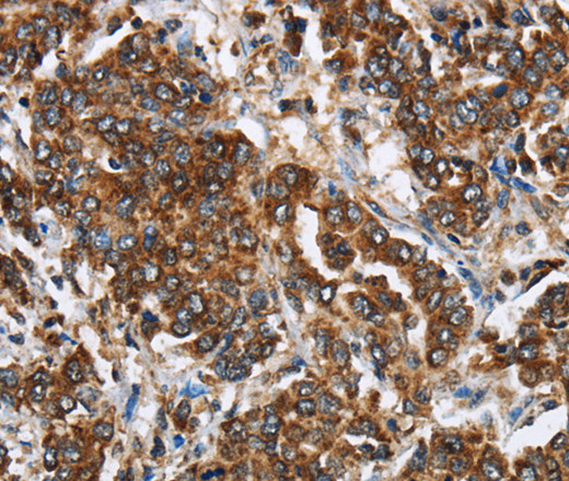 Immunohistochemistry of paraffin-embedded Human liver cancer tissue using GGCX Polyclonal Antibody at dilution 1:60