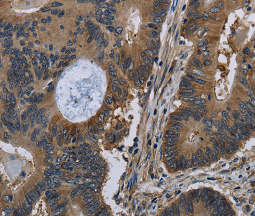 Immunohistochemistry of paraffin-embedded Human colon cancer tissue using TSC22D3 Polyclonal Antibody at dilution 1:40