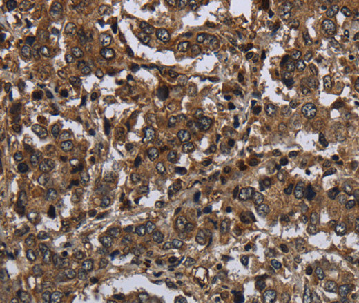 Immunohistochemistry of paraffin-embedded Human liver cancer tissue using GLIPR1 Polyclonal Antibody at dilution 1:50