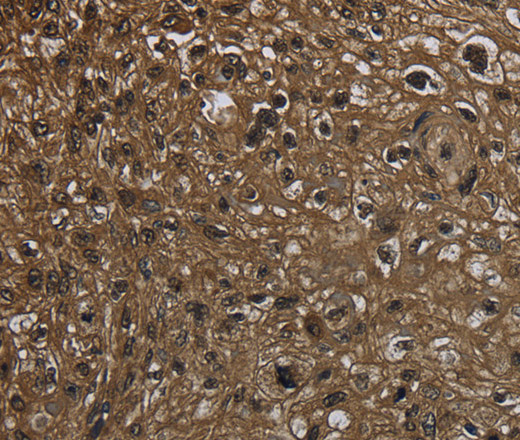 Immunohistochemistry of paraffin-embedded Human esophagus cancer using GLO1 Polyclonal Antibody at dilution of 1:50