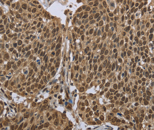 Immunohistochemistry of paraffin-embedded Human cervical cancer using PPAT Polyclonal Antibody at dilution of 1:50