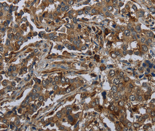 Immunohistochemistry of paraffin-embedded Human liver cancer using GLUL Polyclonal Antibody at dilution of 1:60