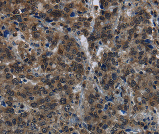 Immunohistochemistry of paraffin-embedded Human liver cancer tissue using GK1 Polyclonal Antibody at dilution 1:60