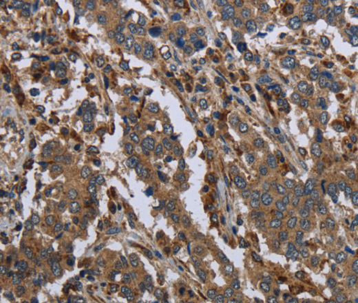 Immunohistochemistry of paraffin-embedded Human liver cancer tissue using GYS2 Polyclonal Antibody at dilution 1:40