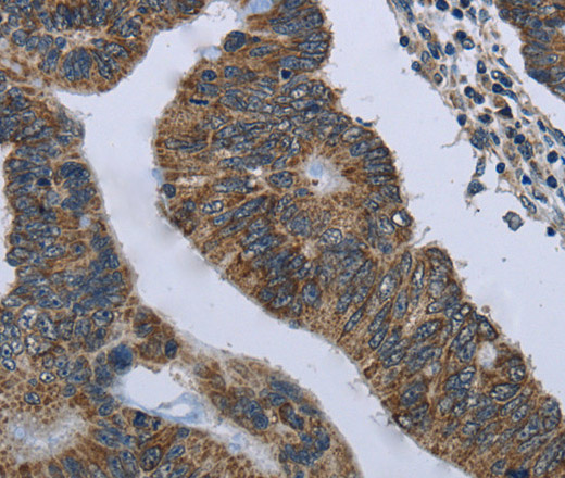 Immunohistochemistry of paraffin-embedded Human colon cancer tissue using CD236 Polyclonal Antibody at dilution 1:60