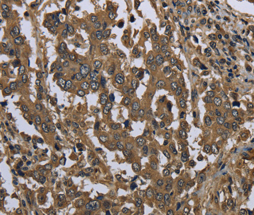 Immunohistochemistry of paraffin-embedded Human liver cancer using GOLGA2 Polyclonal Antibody at dilution of 1:60