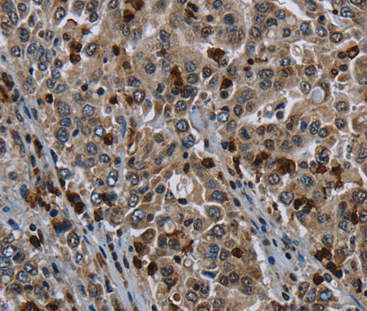 Immunohistochemistry of paraffin-embedded Human liver cancer tissue using CD42b Polyclonal Antibody at dilution 1:50