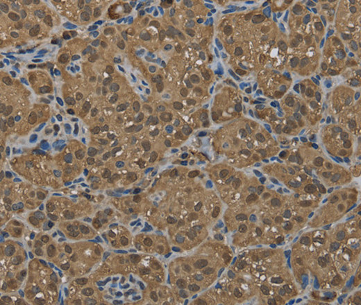 Immunohistochemistry of paraffin-embedded Human thyroid cancer using GSTP1 Polyclonal Antibody at dilution of 1:60