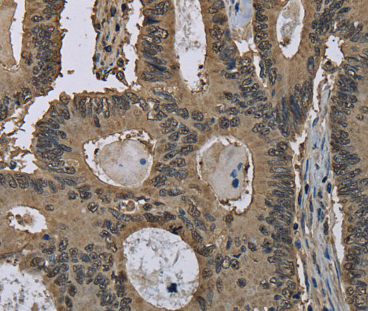 Immunohistochemistry of paraffin-embedded Human colon cancer using GSTP1 Polyclonal Antibody at dilution of 1:60