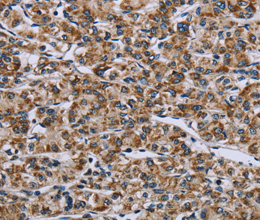 Immunohistochemistry of paraffin-embedded Human prostate cancer tissue using GTPBP10 Polyclonal Antibody at dilution 1:60