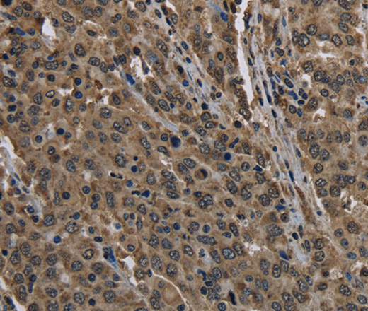 Immunohistochemistry of paraffin-embedded Human liver cancer using HIST1H2AH Polyclonal Antibody at dilution of 1:40