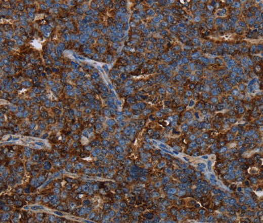 Immunohistochemistry of paraffin-embedded Human ovarian cancer using HMGCL Polyclonal Antibody at dilution of 1:30