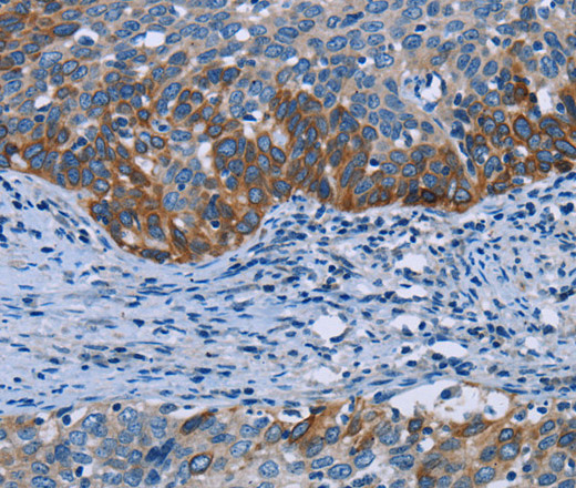 Immunohistochemistry of paraffin-embedded Human cervical cancer using HOMER1 Polyclonal Antibody at dilution of 1:50