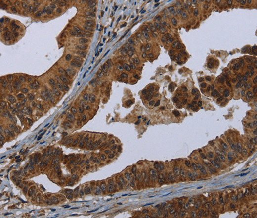 Immunohistochemistry of paraffin-embedded Human gastric cancer tissue using HOMER2 Polyclonal Antibody at dilution 1:30