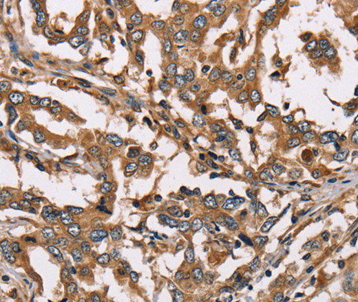 Immunohistochemistry of paraffin-embedded Human liver cancer using HSD17B12 Polyclonal Antibody at dilution of 1:40