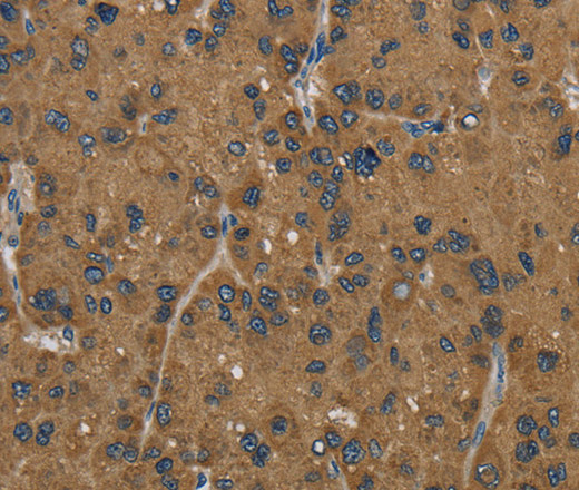 Immunohistochemistry of paraffin-embedded Human liver cancer tissue using HSD17B2 Polyclonal Antibody at dilution 1:50