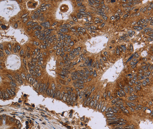 Immunohistochemistry of paraffin-embedded Human colon cancer using HSD17B4 Polyclonal Antibody at dilution of 1:30