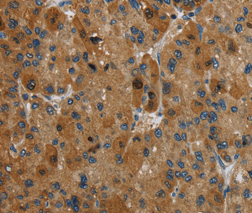 Immunohistochemistry of paraffin-embedded Human liver cancer tissue using HSD17B14 Polyclonal Antibody at dilution 1:40