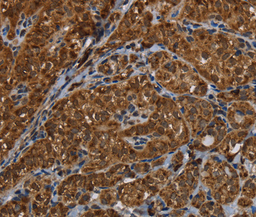 Immunohistochemistry of paraffin-embedded Human thyroid cancer using HSD17B13 Polyclonal Antibody at dilution of 1:30