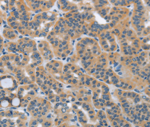 Immunohistochemistry of paraffin-embedded Human thyroid cancer using HSD3B1 Polyclonal Antibody at dilution of 1:40