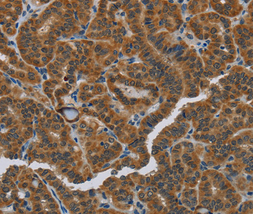 Immunohistochemistry of paraffin-embedded Human thyroid cancer using HSD3B7 Polyclonal Antibody at dilution of 1:40