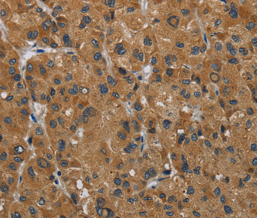 Immunohistochemistry of paraffin-embedded Human liver cancer using HSD3B7 Polyclonal Antibody at dilution of 1:40