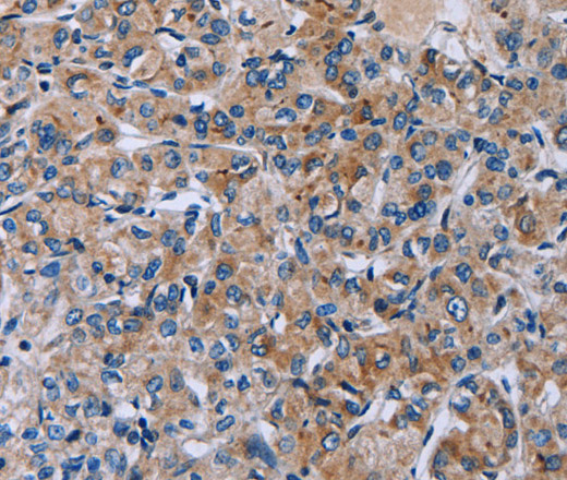 Immunohistochemistry of paraffin-embedded Human prostate cancer tissue using HSD3B2 Polyclonal Antibody at dilution 1:50