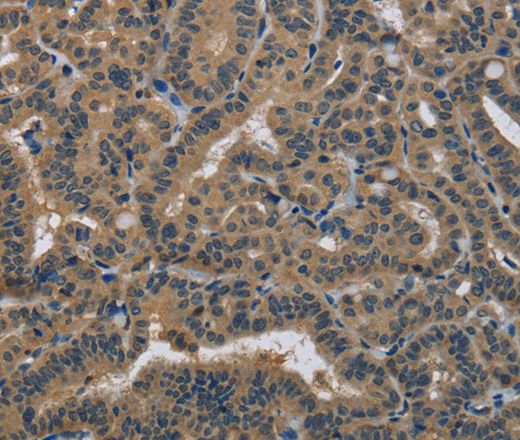 Immunohistochemistry of paraffin-embedded Human thyroid cancer using HSP40-4 Polyclonal Antibody at dilution of 1:30