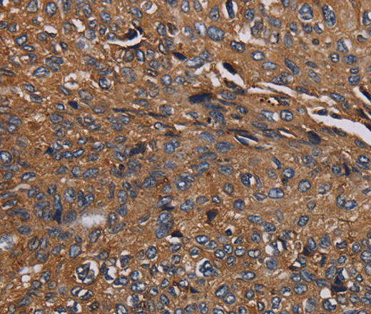 Immunohistochemistry of paraffin-embedded Human renal cancer tissue using HYAL2 Polyclonal Antibody at dilution 1:40