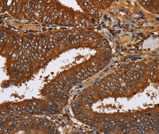 Immunohistochemistry of paraffin-embedded Human colon cancer tissue using TICAM2 Polyclonal Antibody at dilution 1:60