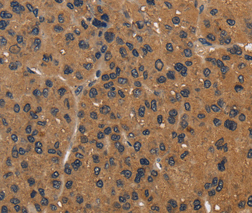 Immunohistochemistry of paraffin-embedded Human liver cancer using CD242 Polyclonal Antibody at dilution of 1:50