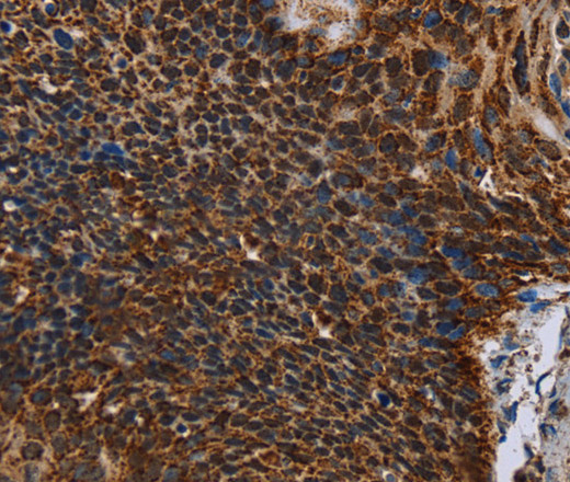 Immunohistochemistry of paraffin-embedded Human cervical cancer using IDH2 Polyclonal Antibody at dilution of 1:60