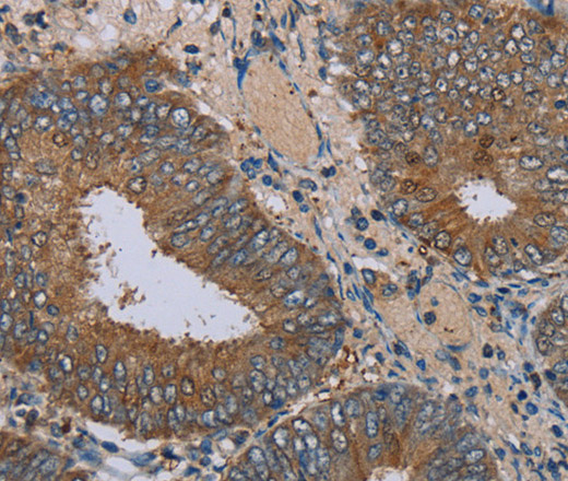 Immunohistochemistry of paraffin-embedded Human colon cancer tissue using IFRD1 Polyclonal Antibody at dilution 1:30