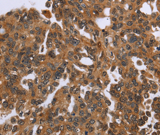 Immunohistochemistry of paraffin-embedded Human ovarian cancer tissue using IHH Polyclonal Antibody at dilution 1:50