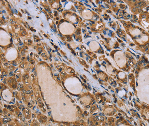 Immunohistochemistry of paraffin-embedded Human thyroid cancer tissue using IKBKE Polyclonal Antibody at dilution 1:30