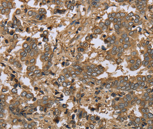 Immunohistochemistry of paraffin-embedded Human liver cancer tissue using IKBIP Polyclonal Antibody at dilution 1:30