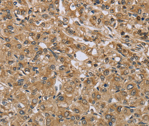 Immunohistochemistry of paraffin-embedded Human prostate cancer using TXLNA Polyclonal Antibody at dilution of 1:30