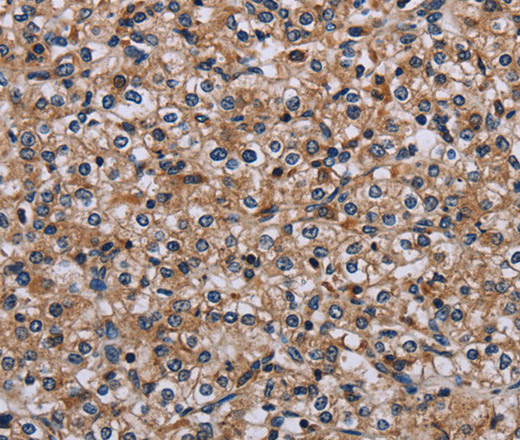 Immunohistochemistry of paraffin-embedded Human prostate cancer using IPO4 Polyclonal Antibody at dilution of 1:50