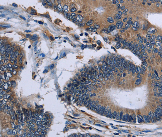 Immunohistochemistry of paraffin-embedded Human colon cancer using IPO4 Polyclonal Antibody at dilution of 1:50