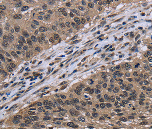 Immunohistochemistry of paraffin-embedded Human lung cancer using ITGAE Polyclonal Antibody at dilution of 1:60